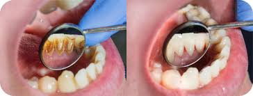 Dental hygienist at work